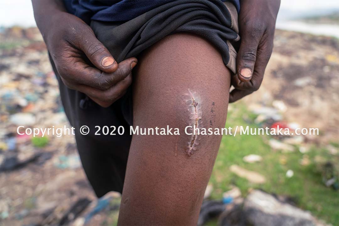 Agbogbloshie child labour: Kwadjo Esien, 14 years, is engaged in hazardous child labour at Agbogbloshie in Accra, Ghana. He was cut by broken CRT glass in early September 2020. Copyright © 2020 Muntaka Chasant