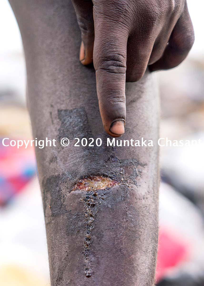 An 11-year-old boy badly cut by a magnet attached to an old school subwoofer he was using to attract small metals in the soil. Copyright © 2020 Muntaka Chasant